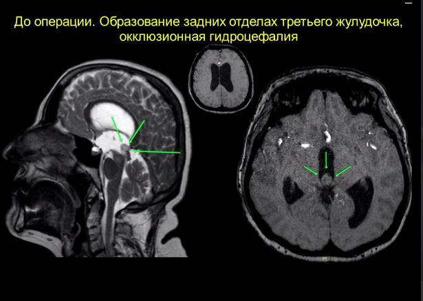 In Tajikistan, for the first time, a successful operation was performed to remove a deep-seated tumor of the third ventricle of the brain.