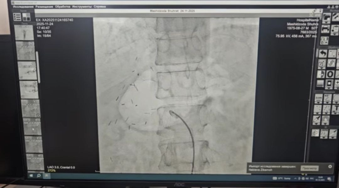 In Tajikistan, for the first time after a liver transplant, splenial artery embolization was performed.